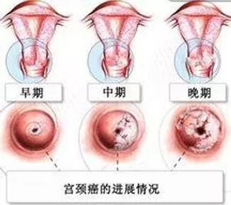 杭州市临平区HPV宫颈癌疫苗接种点地址及预约咨询电话